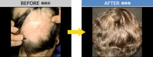 円形脱毛症　治療症例2