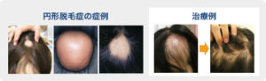円形脱毛症症例、治療